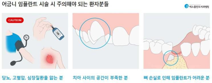 튼튼함이중요한어금니임플란트 관련 이미지 3