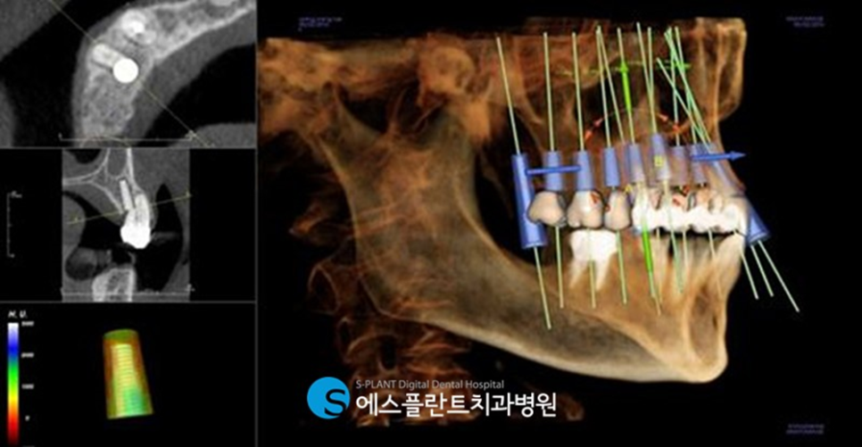압구정로데오역치과 임플란트 잘하는 치과, 에스플란트 치과병원에서 실제로 사용하는 가이드 임플란트란?! 관련 이미지 3