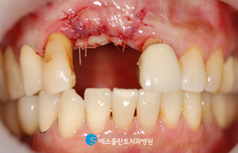 에스플란트치과병원의 잇몸이식술(Connective Tissue Graft, CTG) 로 단단한 잇몸 만들기 관련 이미지 5