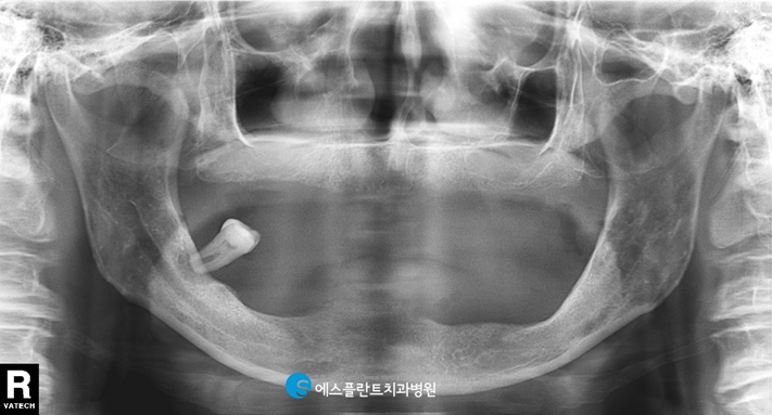 임플란트와 틀니의 장점만 모은 임플란트틀니 관련 이미지 4