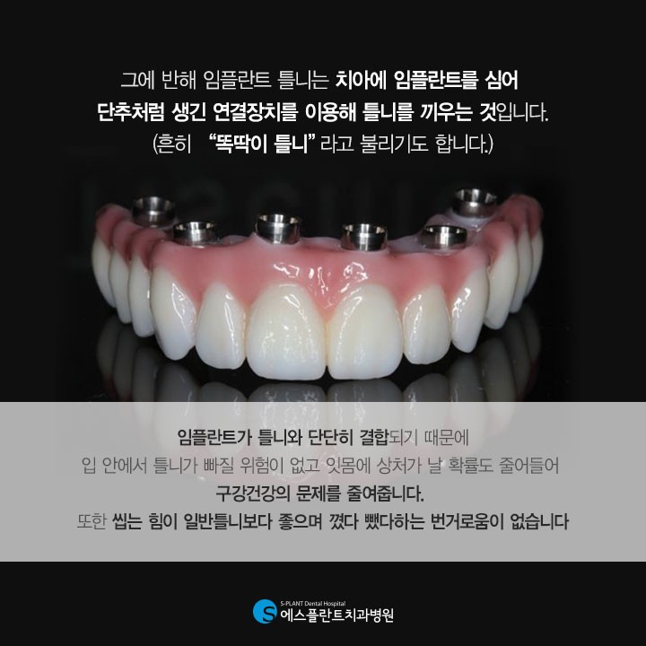 임플란트 틀니랑 일반 틀니랑 뭐가 달라요?[임플란트 틀니] 관련 이미지 4