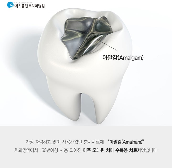 아무도 몰랐던 비밀스러운 [아말감] 관련 이미지 1