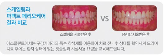 [치과 스케일링] 아프고 비싼 치과치료, 치료보다 중요한 것은 바로 예방 입니다. 관련 이미지 5