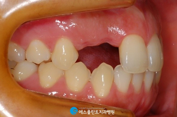 상악 전치부 임플란트로 심미성을 회복하세요. 관련 이미지 2