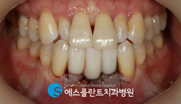 뻐 폭이 좁은 아래 앞니 임플란트 잘하는 치과, 강남 에스플란트치과병원 관련 이미지 6