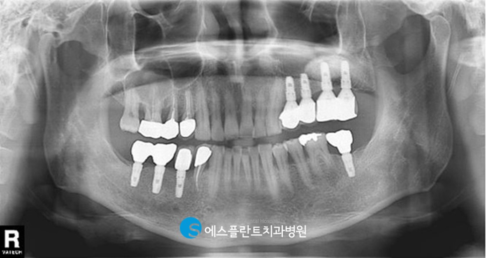 에스플란트치과병원의 고난이도 상악동 거상술을 동반한 임플란트 식립 후 10년 경과 케이스 관련 이미지 8