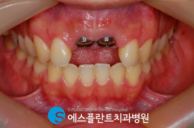 부러지고, 깨진 앞니!  앞니임플란트로 원래의 모습을 되찾을 수 있습니다. 관련 이미지 3