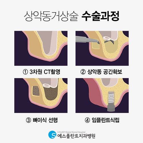 상악동거상술 의료진의 수준이 결과를 결정해 [에스플란트치과병원] 관련 이미지 5