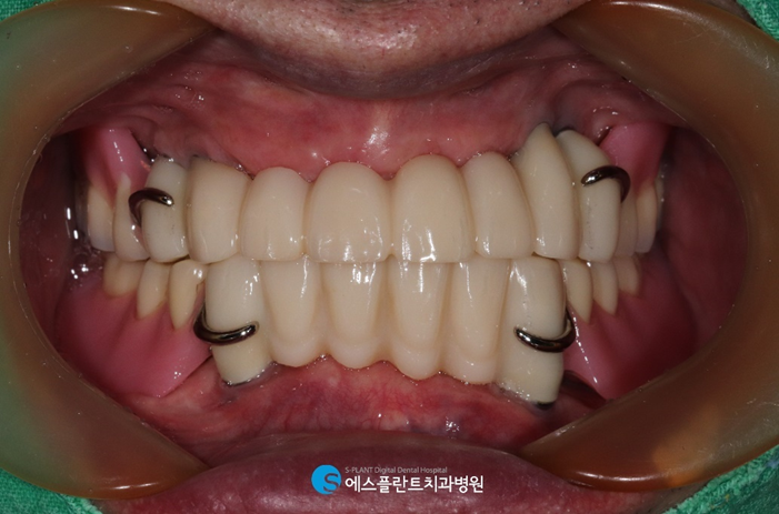 임플란트와 틀니의 장점만 모은 임플란트틀니 관련 이미지 9