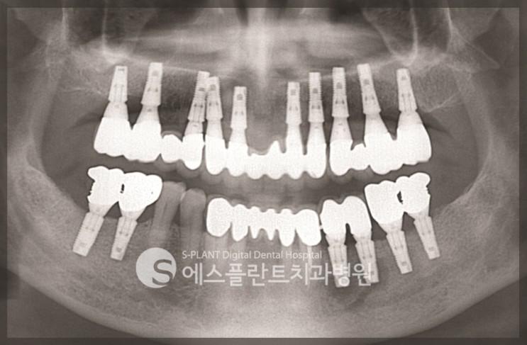 무치악환자,전악임플란트 통해 새로운삶 얻어 관련 이미지 11