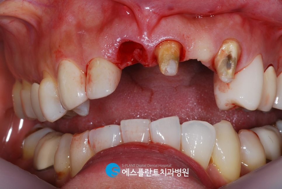 전치부 치근외흡수로 인한 임플란트 시술이 가능한 치과, 강남 에스플란트치과병원 관련 이미지 6