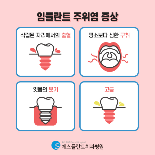 실패한 임플란트도 살리는 에스플란트 치과병원 관련 이미지 3