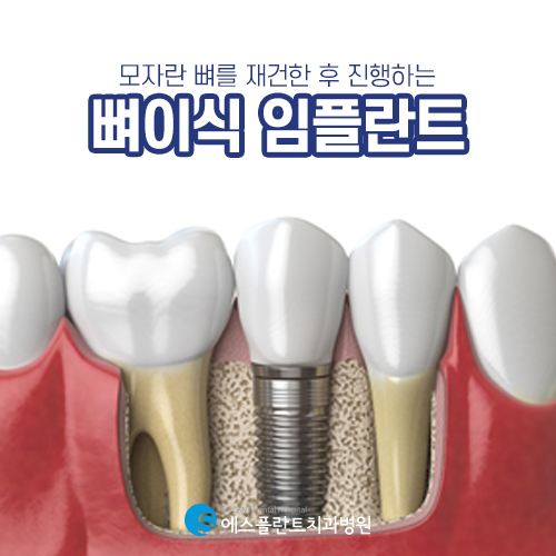 뼈이식 임플란트, 에스플란트의 충분한 상담을 통해 안전하게 진행 관련 이미지 3