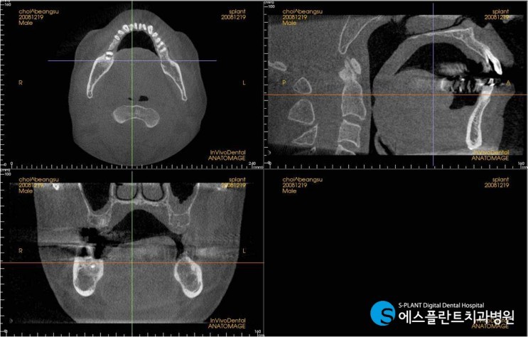 [안전하고 빠르고 오래가는 임플란트] 치료기간 12개월 너무 길죠? 관련 이미지 2