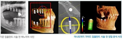 임플란트가격, 임플란트가격비교 기준은? 관련 이미지 8