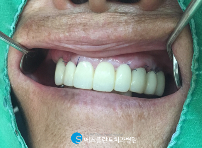 치아를 즉시 사용해야 한다면? 에스플란트치과에서 즉시기능임플란트 하세요! 관련 이미지 6