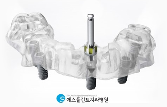 빠른 회복이 가능한 네비게이션임플란트 관련 이미지 2