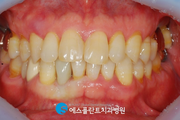 웃을 때 잘 보이는 전치부!하악 전치부 임플란트 치료 사례입니다. 관련 이미지 4