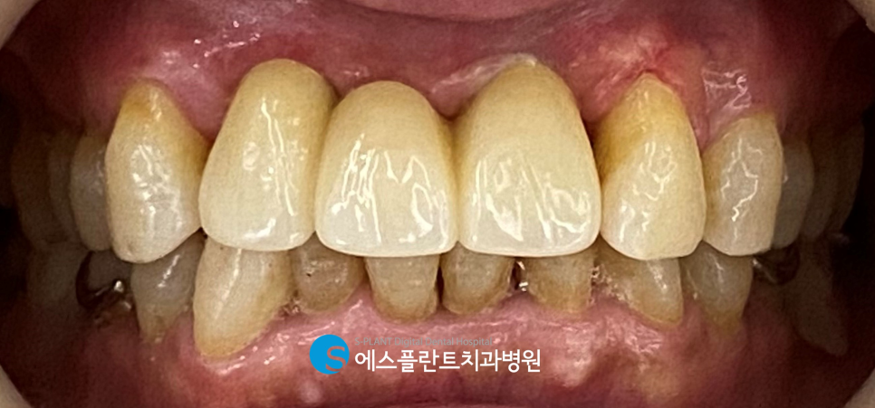 심한 골흡수가 있는 전치부 임플란트 잘하는 강남치과, 에스플란트치과병원 관련 이미지 7