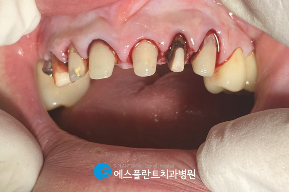 기능성과 심미성 모두 고려한 전치부 지르코니아 심미보철은 청담 에스플란트치과병원에서 관련 이미지 4