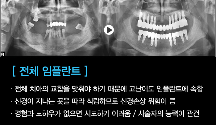 네비게이션 임플란트 통해 전체 임플란트 또한 안전하게, 가격 보다 기술력이 중요해. 관련 이미지 9