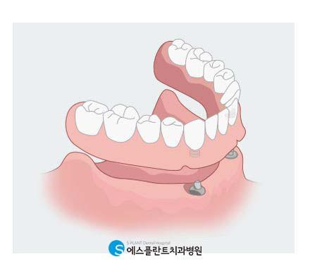 단단한고정으로걱정없는임플란트틀니 관련 이미지 2