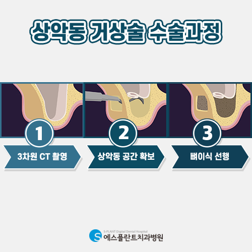상악동거상술, 어려운 수술인 만큼 의료진의 실력이 중요합니다 [에스플란트치과] 관련 이미지 3