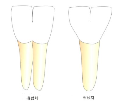 치아 기형, 융합치와 쌍생치란? [에스플란트 치과병원] 관련 이미지 2