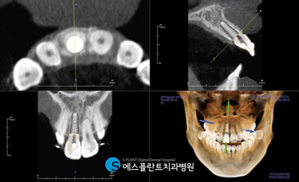 압구정로데오역치과 임플란트 잘하는 치과, 에스플란트 치과병원에서 실제로 사용하는 가이드 임플란트란?! 관련 이미지 4