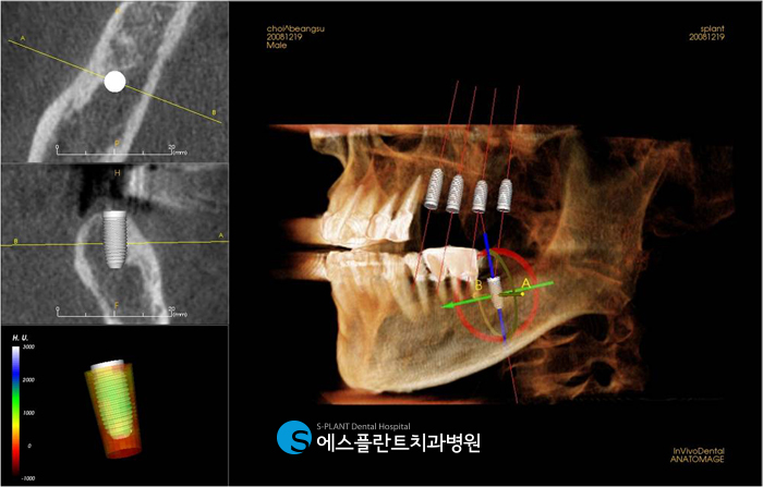 Gangnam Molar Implants: What Should You Consider When Choosing a Dental Clinic?! image 4