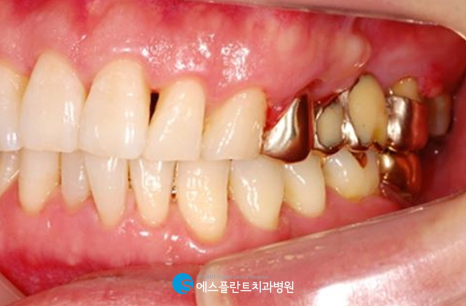 에스플란트치과병원의 고난이도 상악동 거상술을 동반한 임플란트 식립 후 10년 경과 케이스 관련 이미지 3