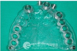 [즉시 기능 임플란트] 당일 임플란트, 즉시 기능 임플란트는 아나토마지 가이드 임플란트로! 관련 이미지 4