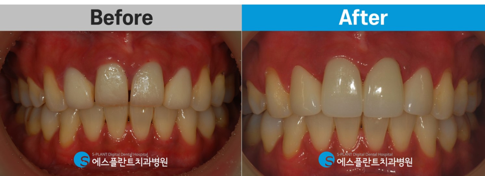 압구정로데오 앞니 벌어짐 정중이개 치료 잘하는 치과, 에스플란트치과병원의 전치부 심미보철 관련 이미지 7