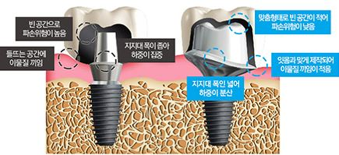 첫인상을 좌우하는 앞니를 상실했다면? 앞니 임플란트 하세요! 관련 이미지 4