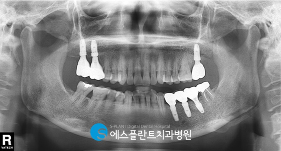 강남 압구정로데오 임플란트 잘하는 치과, 에스플란트치과병원의 브릿지 제거 후 임플란트 식립 관련 이미지 6