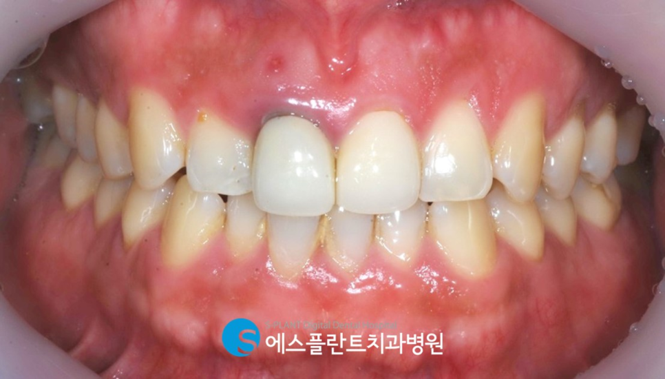 강남 심미보철 잘하는 치과, 에스플란트치과병원에서 알려드리는 오래된 앞니 보철물 교체 관련 이미지 2