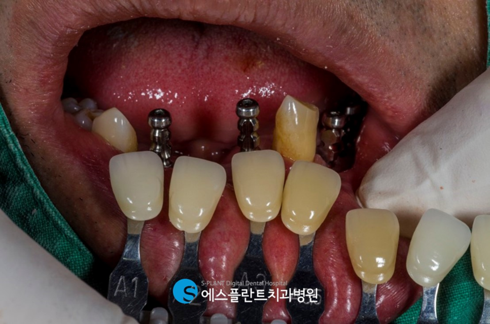 압구정 임플란트, 에스플란트치과병원의 편안하고 정확한 식립이 가능한 전악 가이드 임플란트 관련 이미지 9