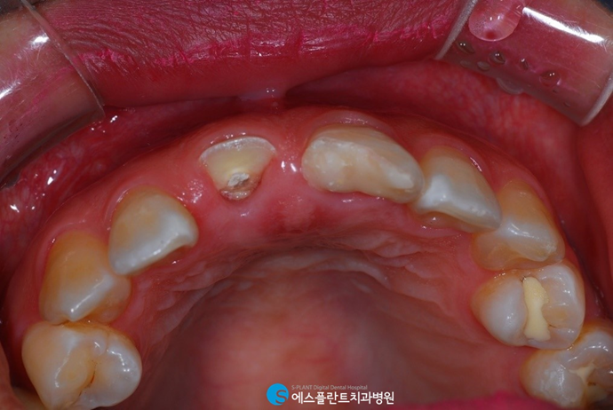 치아가 1/2 이상 부러졌다면? 크라운 치료 진행하세요. 관련 이미지 3