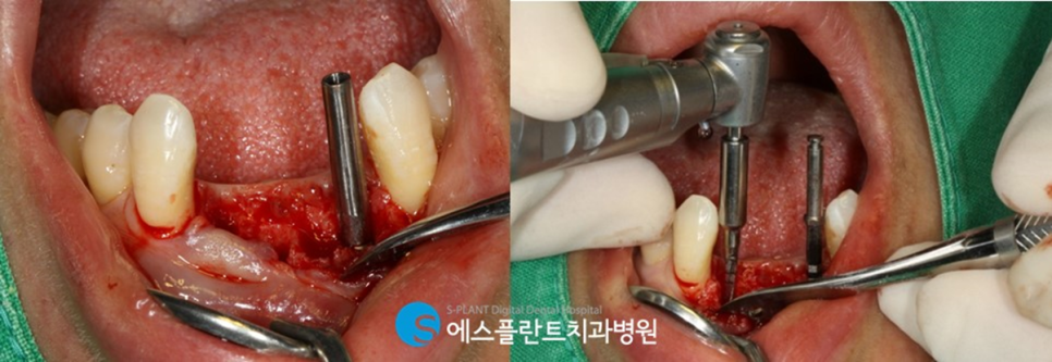 뻐 폭이 좁은 아래 앞니 임플란트 잘하는 치과, 강남 에스플란트치과병원 관련 이미지 4