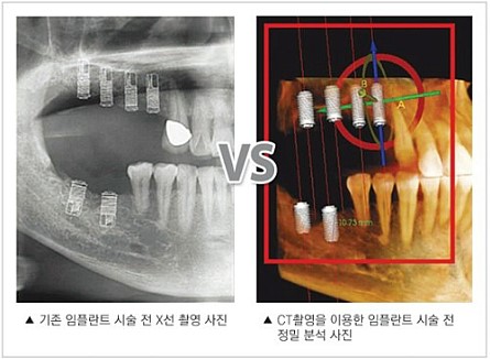 어금니 임플란트, CT촬영이 중요한 어금니 임플란트!! 관련 이미지 7