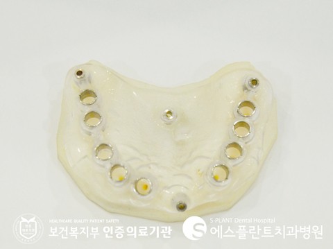 [학동사거리 임플란트 치과] 임플란트 잘하는 에스플란트치과병원의 안 전한 가이드 임플란트 수술! 관련 이미지 2