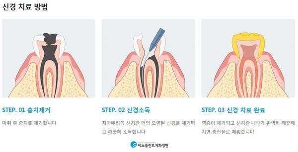 충치치료,내구성이뛰어난인레이로치아보존 관련 이미지 4