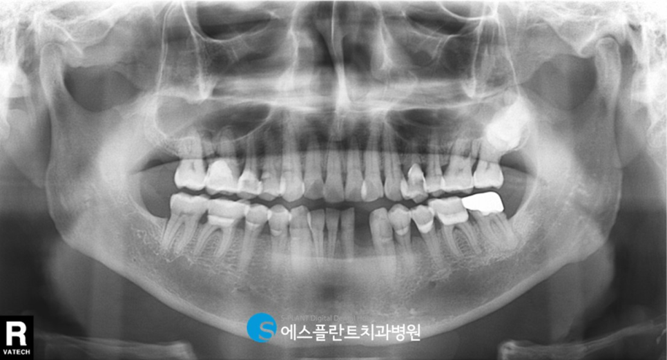 압구정로데오 임플란트 잘하는 치과, 만성치주염으로 인해 빠져버린 치아 뼈이식을 동반한 하악 앞니 임플란트 관련 이미지 2