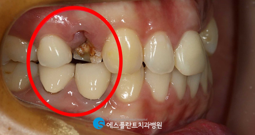 고난이도 앞니 심미 임플란트는 강남 에스플란트치과병원에서 관련 이미지 3