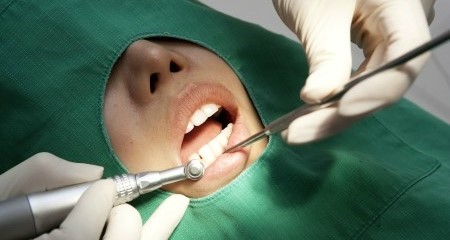 [자가미백효과] 자가치아미백 주의사항, 자가치아미백 과정 관련 이미지 3