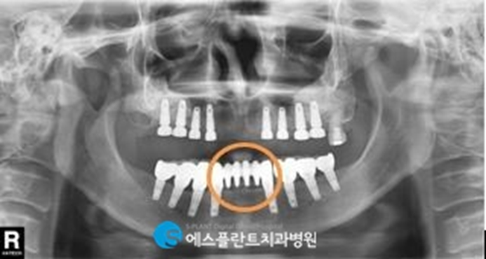 전악임플란트로 치아 기능을 회복하세요! <전악임플란트 치료사례> 관련 이미지 4