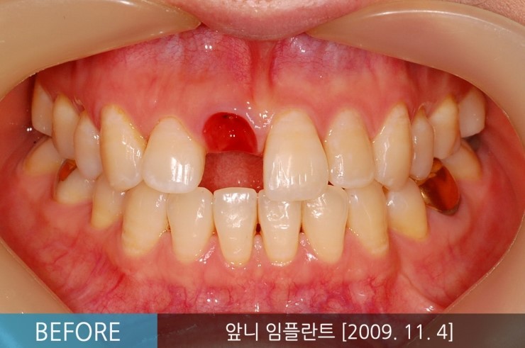 [앞니임플란트기간] 앞니임플란트, 당일 발치 후 즉시 식립 임플란트 CASE 관련 이미지 1