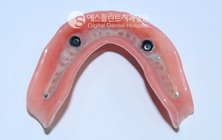 임플란트 틀니 잘하는 곳 "에스플란트치과병원" 관련 이미지 1