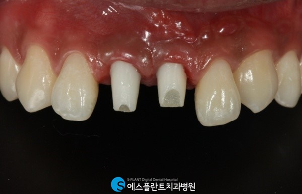 사고로 파절 된 앞니! 에스플란트치과에서 앞니임플란트로 심미성을 회복하세요! 관련 이미지 5