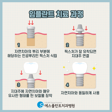 임플란트 치료과정과 주의사항 관련 이미지 3